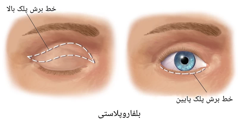 تصویر تفاوت بلفاروپلاستی پلک بالا و پایین