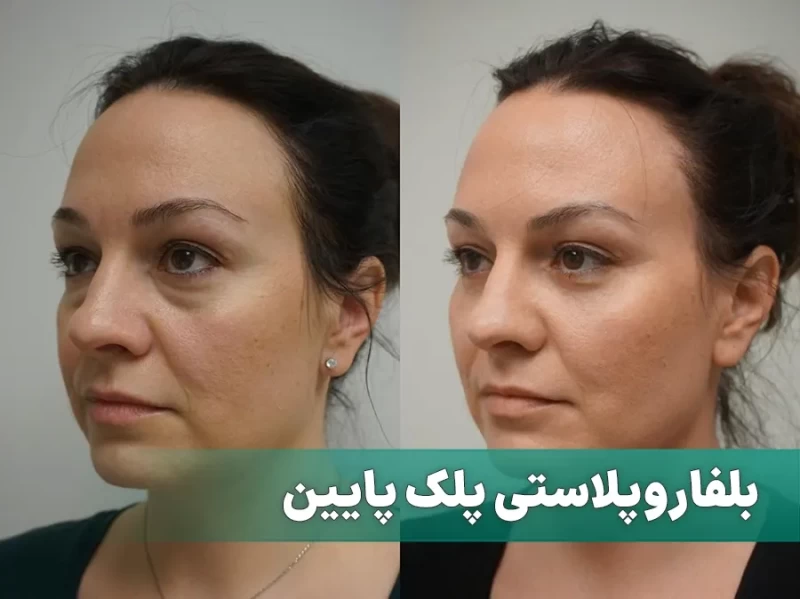 جراحی پلک پایین