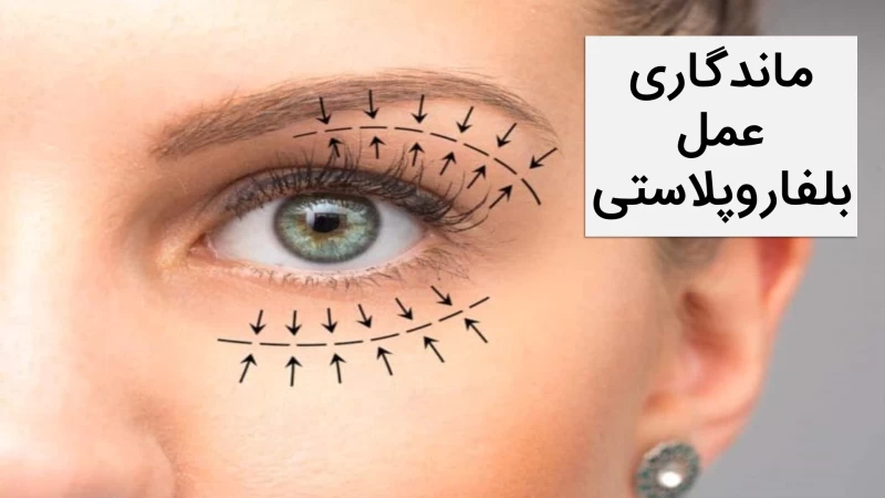 ماندگاری عمل بلفاروپلاستی