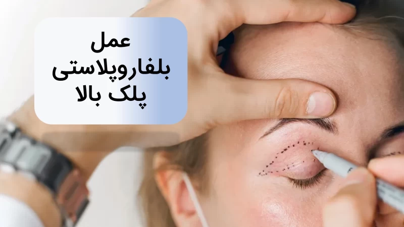 بلفاروپلاستی پلک بالا