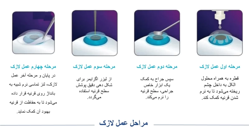 مراحل عمل لازک
